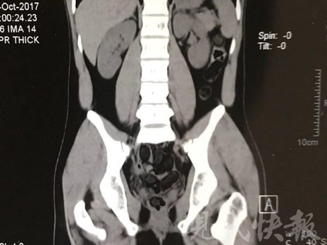 小伙體內(nèi)藏毒300余克 CT掃描圖密密麻麻全是蠶蛹